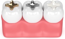 "Say Goodbye To Cavities Through Dental Filling Procedure"