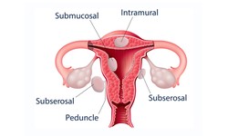 Why is UFE also called Uterine Artery Embolization?