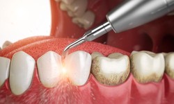 How Long are Dentist Cleanings: Understanding the Duration and Importance of Routine Teeth Cleanings