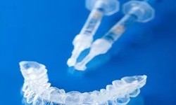 Teeth Straightening - How much it Cost?