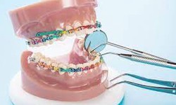 Why straight teeth are important for your overall health: Insights from Birmingham orthodontists