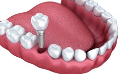 What should you know about dental implants?