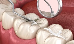 Dental Sealants: An Affordable Way to Prevent Cavities