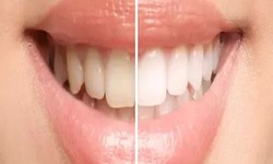 Get a Brighter, Whiter Smile With Our Teeth Whitening