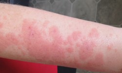 What are the symptoms of having Sun Allergy on the skin?