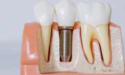 Dental Implants Can Breathe Life Back Into Your Smile
