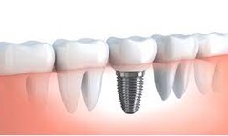 Dental Implant Surgery: Tips for a Successful Procedure in Dubai