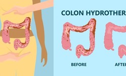 Colon Hydrotherapy: What To Expect And How To Prepare | Medical Massage Detox