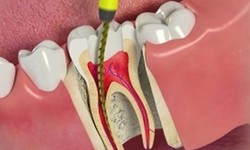 What Is The Procedure For Dental Implants?