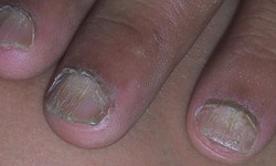 Experienced Finger Nail And Toe Nail Avulsion- What To Do?