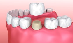 What is the Best Age For Dental Crowns?
