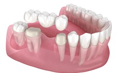 What is a Dental Bridge Procedure?
