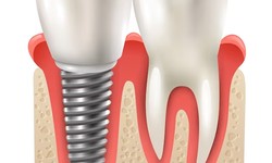 How to Take Care of Your Dental Implants for Long-Term Success
