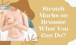 Stretch Marks on Breasts: What You Can Do?