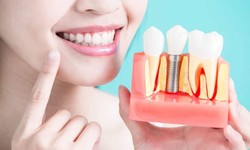 Consultation For Dental Implants: What To Expect & How To Prepare?