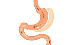 What To Look For In A Gastric Sleeve Surgeon?