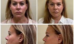 What to Expect During and After a Facelift Procedure
