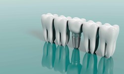 Why Dentures Are Worth Considering For A Brighter Smile?