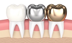 Restoring Your Smile With A Cheap Dental Crown