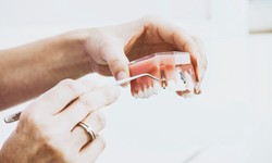 The Denture Implant Journey: Here's What's in Store