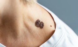 Removing Moles: A Guide to Safe and Effective Mole Removal in Birmingham