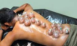 Discover the Powerful Benefits of Hijama Therapy