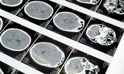 Here’s What A Brain Injury Lawyer Can Do For You