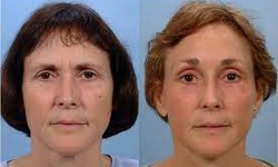 The Importance of Choosing a Qualified Surgeon for Your Face Lift