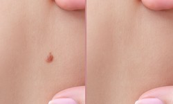 Can Moles Be Removed Permanently?