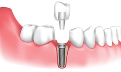 Dental Implant Procedure - What to Expect