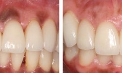 Understanding Gums Depigmentation: Causes, Treatment, and Prevention