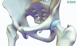 Femoral Acetabular Impingement - What You Should Know?