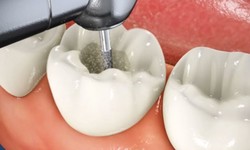 Dos and Don'ts to Follow After a Root Canal Treatment in Bankstown