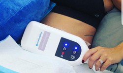 8 Most Frequently Asked Questions About CoolSculpting