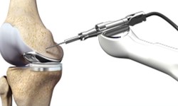 7 Things You Must Know About Robotic Knee Replacement Surgery