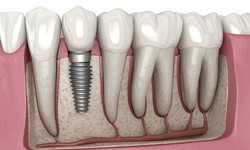 Dental Implants In London : Restoring Smiles With Confidence