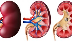 When to Worry About Creatinine Levels: Understanding Low Creatinine and Its Causes