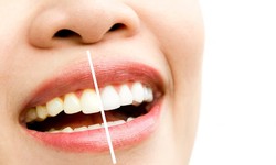 Teeth Whitening 101: Your Guide to a Brighter Smile