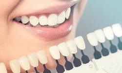 Enhance Your Smile with Dental Veneers by Alexandria Dentists