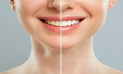 Your Guide to Top Dentists in Morgantown: Finding Your Perfect Smile Partner