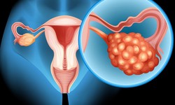 5 Natural Ways to Treat Polycystic Ovary Syndrome (PCOS) Effectively