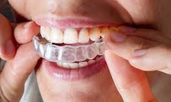 Unveiling Hidden Costs: Things to Consider When Budgeting for Invisalign Treatment