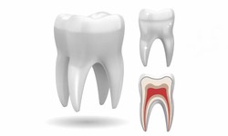 Restoring Smiles with Permanent Tooth Replacement in Huntington Beach