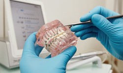 Essential Factors to Consider Before Deciding on a Dental Bridge