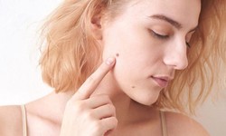 Dermisol Skin Tag Remover (Pros and Cons) Is It Scam Or Trusted?
