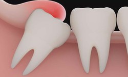 Cheap Wisdom Teeth Removal: What Adults Should Expect