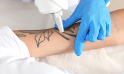 Laser Tattoo Removal Procedure: Benefits and Risks