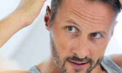 Budget-Friendly Beauty: The Ultimate Guide to Finding the Best Hair Transplant in Turkey for an Amazing Price