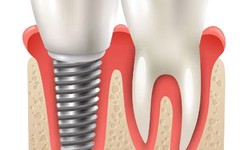 Understanding Dental Implants Cost in Colorado Springs: Investing in Your Smile