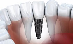 Experience the Benefits of All-on-4 Dental Implants in San Diego